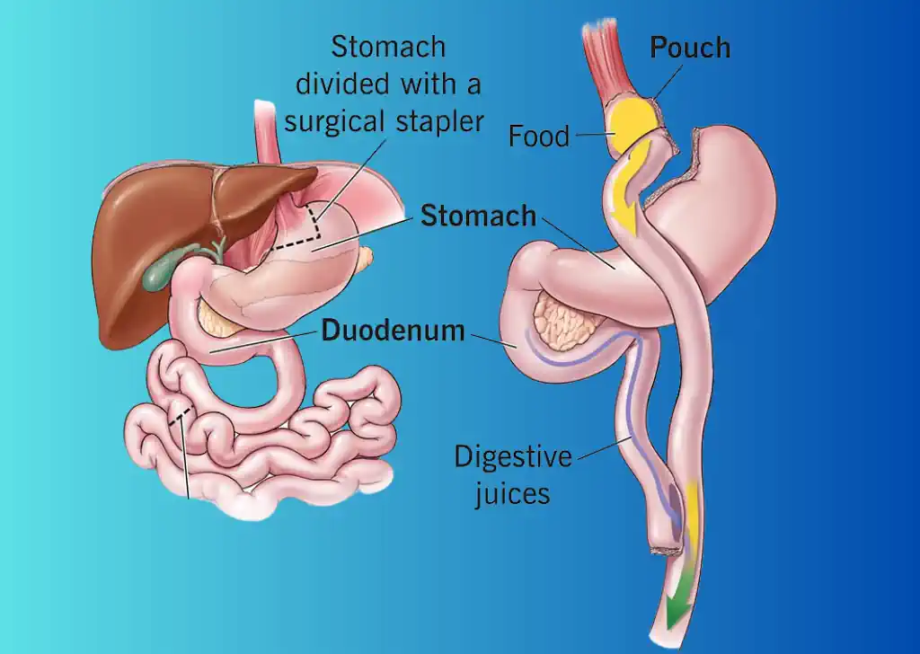 Gastric Bypass Surgery – What are the risks?